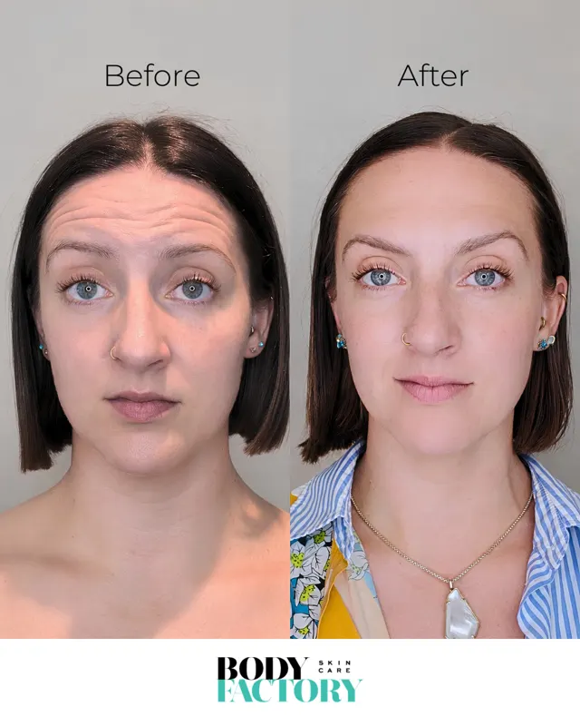 Botox Social Before After Carousel 01