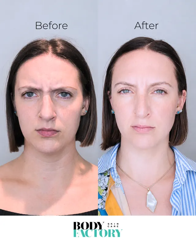 Botox Social Before After Carousel 02