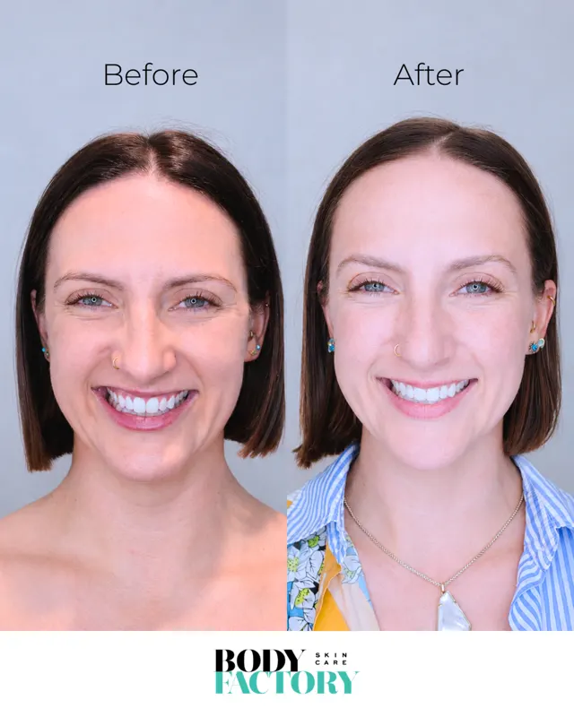 Botox Social Before After Carousel 03
