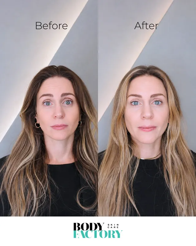 Botox Social Before After Carousel 04