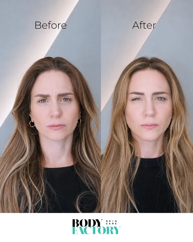 Botox Social Before After Carousel 05