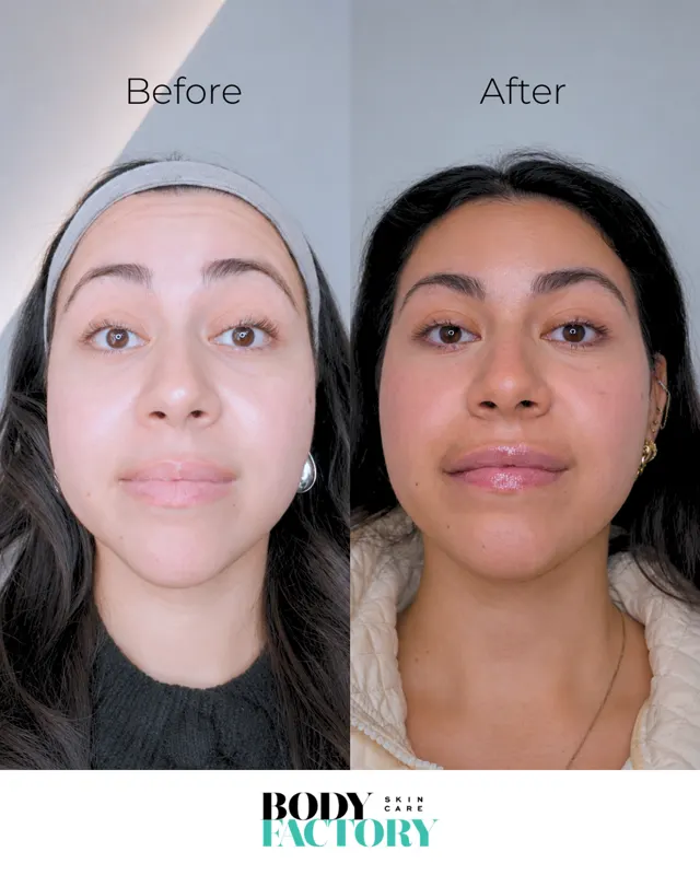 Botox Social Before After Carousel 06