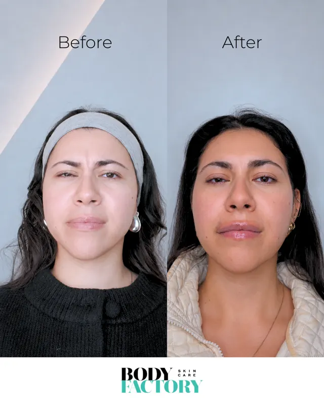 Botox Social Before After Carousel 07
