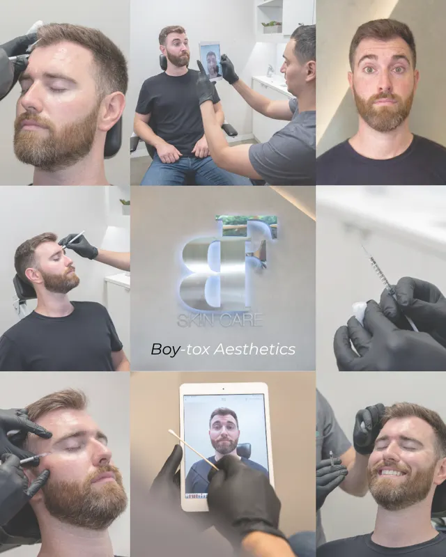 Botox Social Boy Tox 02