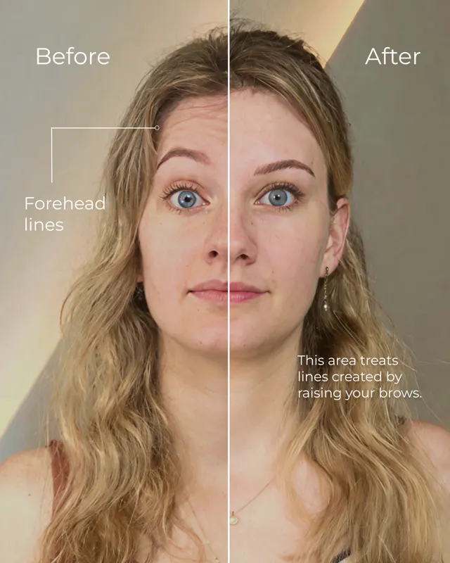 Botox Social Flat Fee400Carousel 01