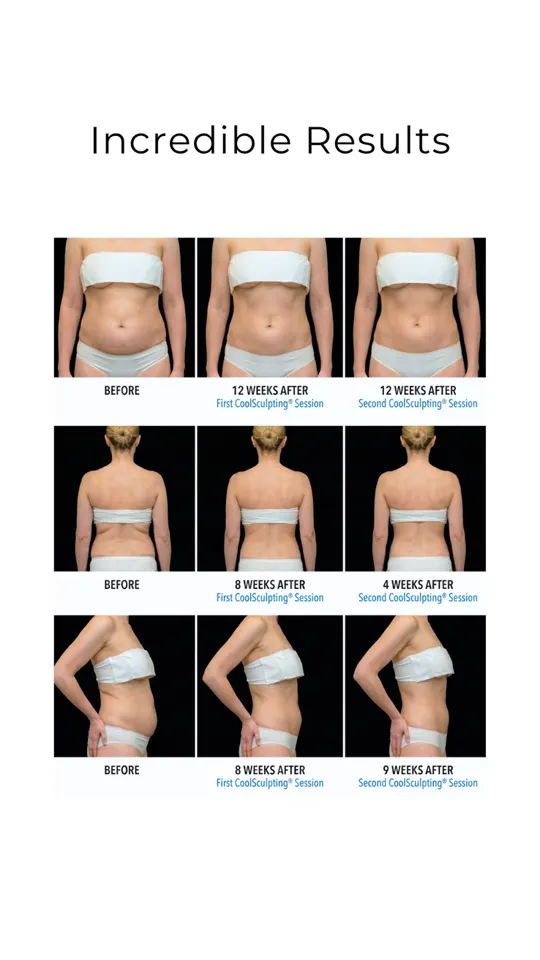 Cool Sculpting Social Carousel 04