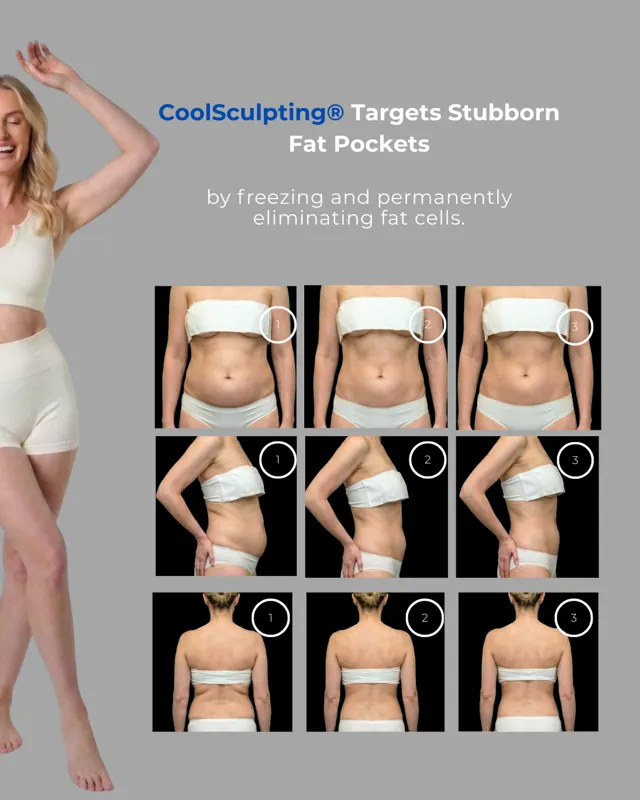 Cool Sculpting Social GLP1Weight Loss Panel 03