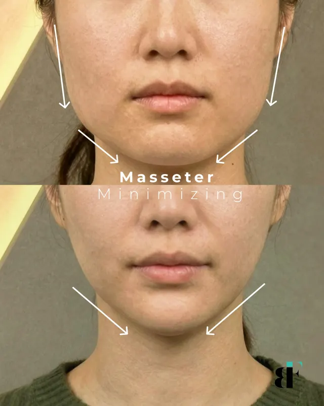 Masseter Social Carousel 05