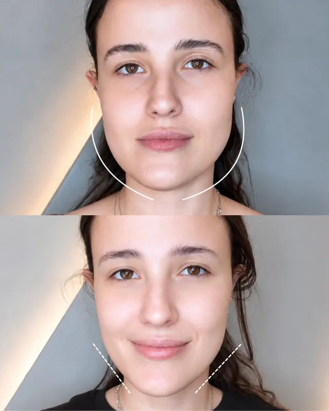 Masseter Social Jawline Treatment 01