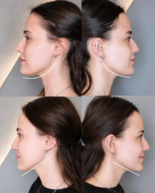 Masseter Social Jawline Treatment 02
